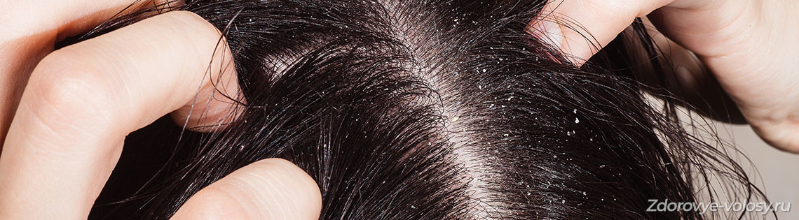 'Выпадение волос при себорее — себорейная алопеция, лечение перхоти