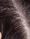 'Выпадение волос при себорее — себорейная алопеция, лечение перхоти