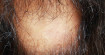 Очаговая алопеция, гнездное облысение – причины выпадения волос, заболевания
