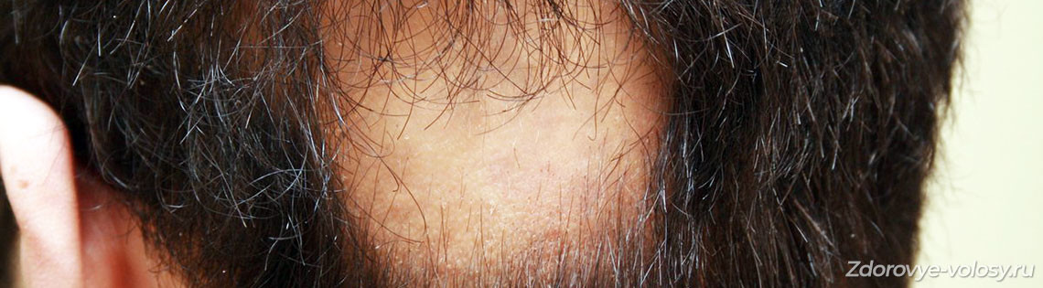 'Очаговая алопеция, гнездное облысение – причины выпадения волос, заболевания