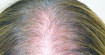 Диффузное выпадение волос у женщин — причины алопеции и лечение