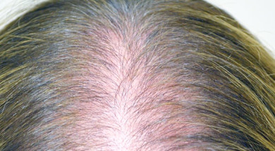 'Диффузное выпадение волос у женщин — причины алопеции и лечение