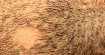 Алопеция бороды у мужчин – как лечить облысение подбородка?