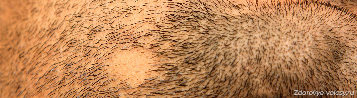'Алопеция бороды у мужчин – как лечить облысение подбородка?