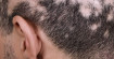 Сифилитическая алопеция – выпадение волос при сифилисе, признаки и лечение