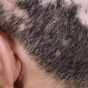 'Сифилитическая алопеция – выпадение волос при сифилисе, признаки и лечение