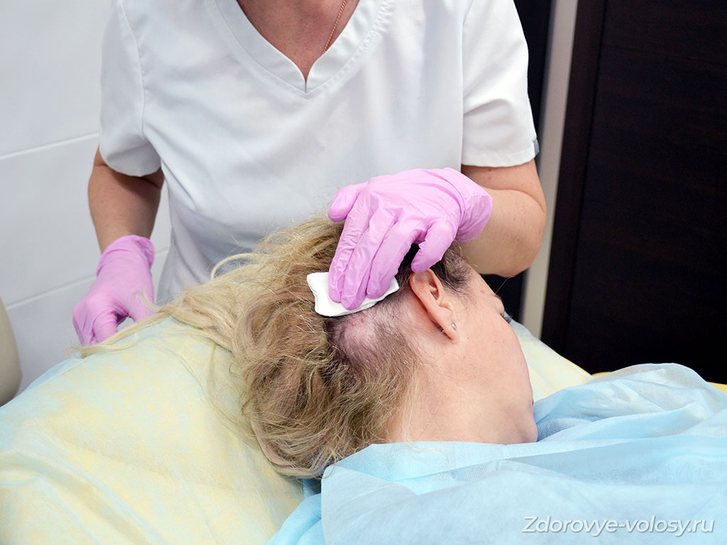 Биопсия соскоб кожи головы у женщины