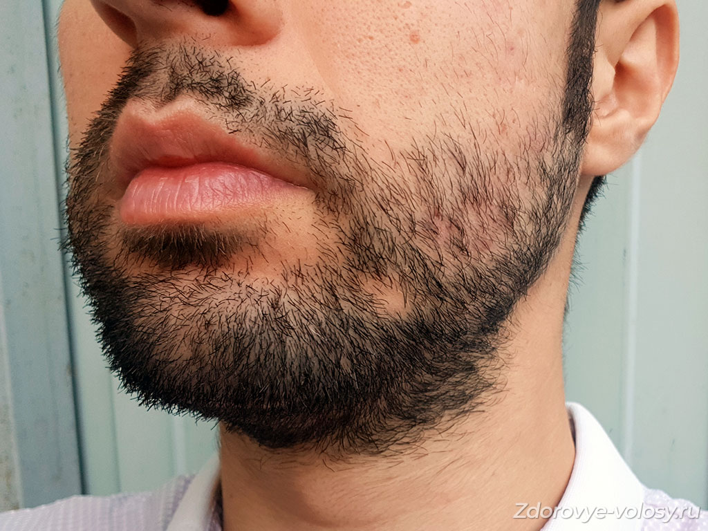 Диффузное и гнездное облысение на бороде
