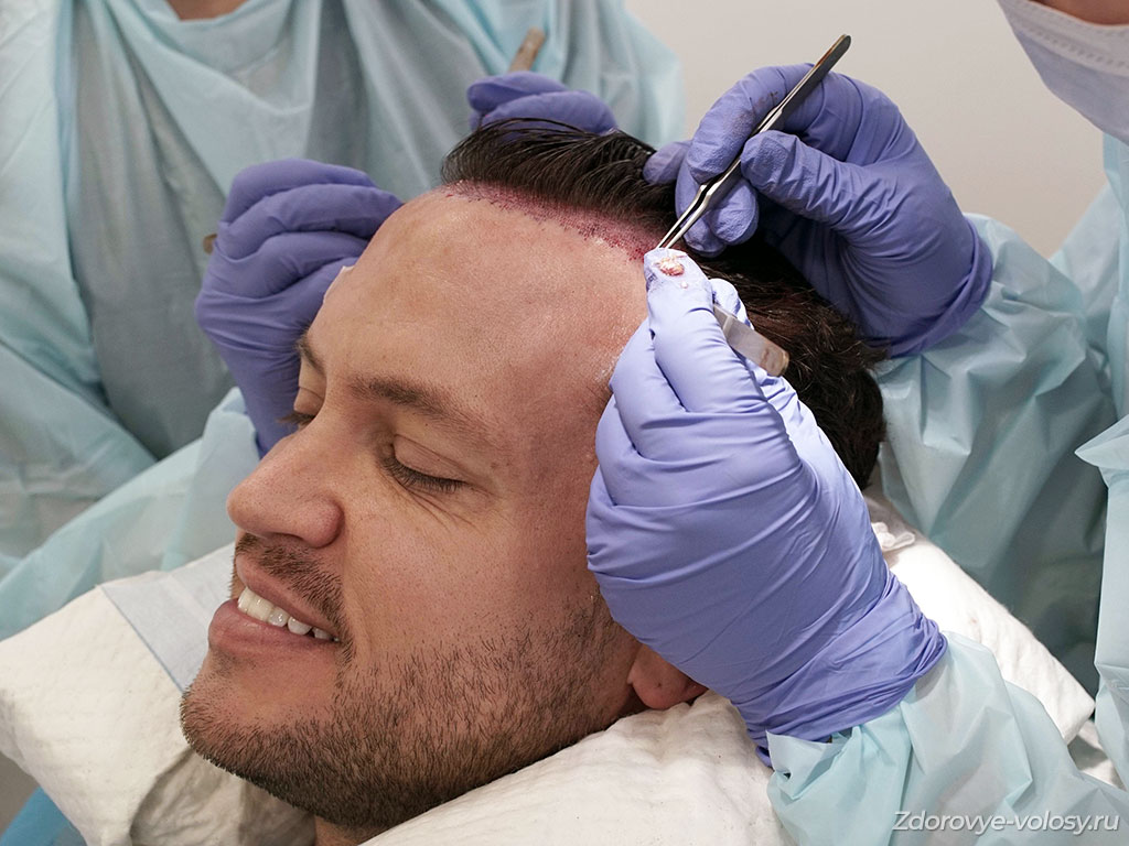 Операция по пересадке волос мужчине