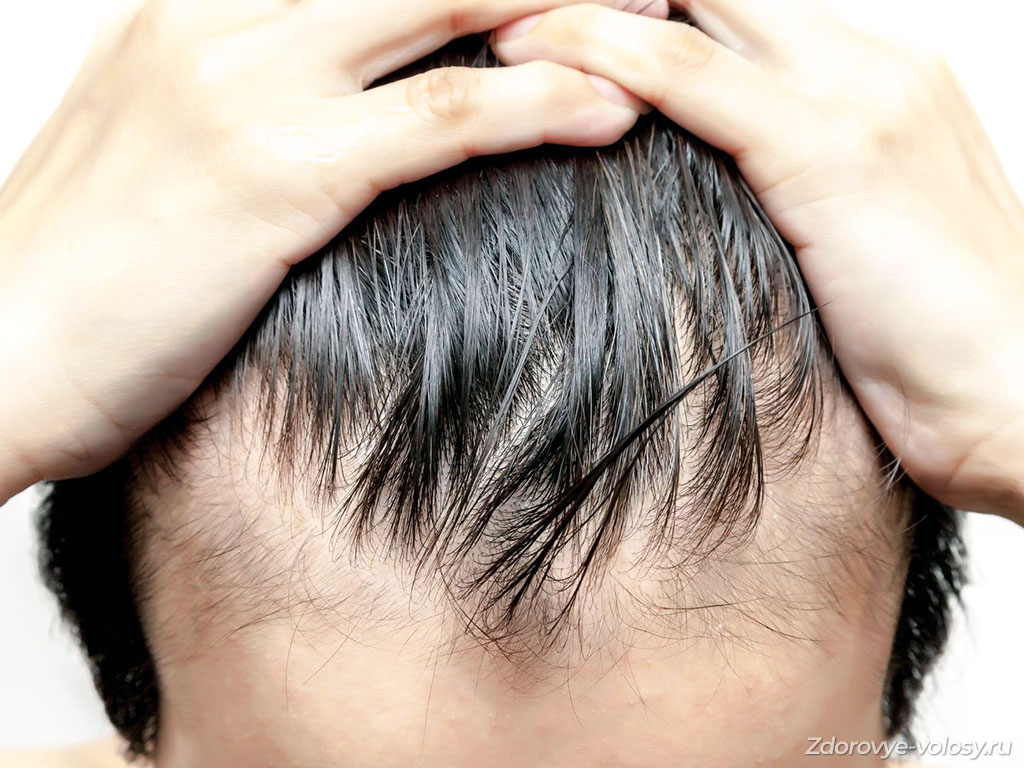 Себорея - выпадение жирных волос
